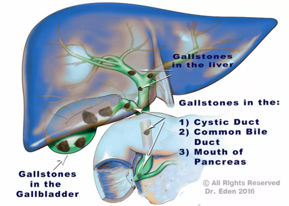 The Gallbladder Cleanse: Fact or Fiction in Treating Gallstones?